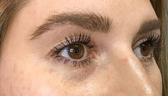 Juvederm Before & After