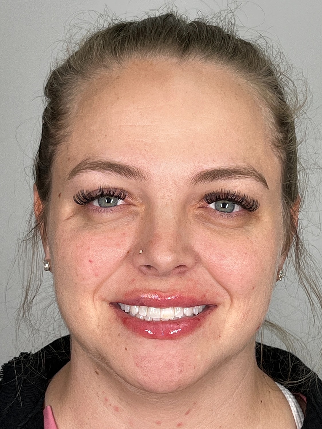 Lip Enhancement Gallery Before & After