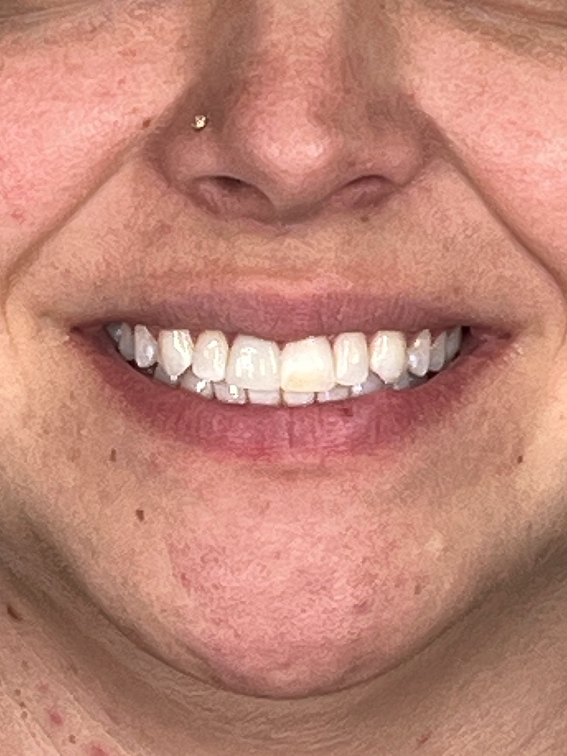Lip Enhancement Gallery Before & After