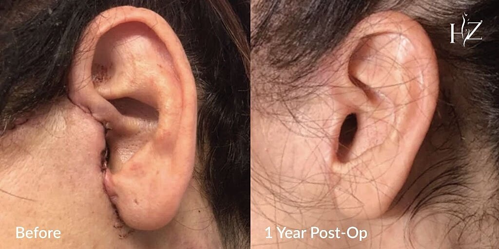 Ear transformation: before and one year post-op.