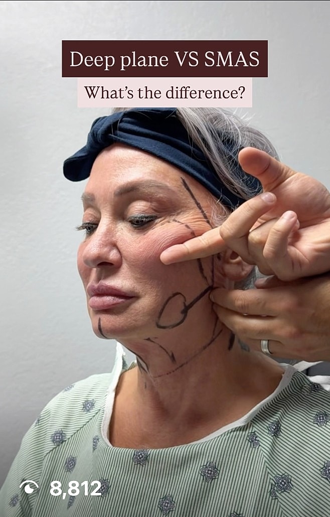 Deep plane facelift versus SMAS technique comparison.