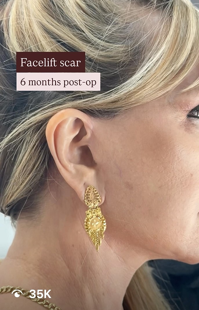 Ear with earring and facelift scar, six months post-op.