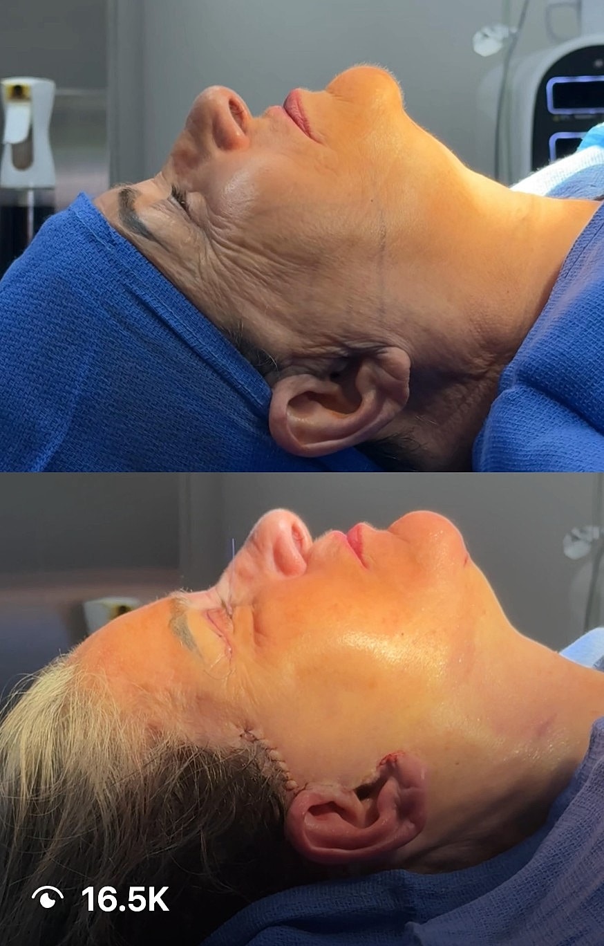 Before and after cosmetic surgery comparison.