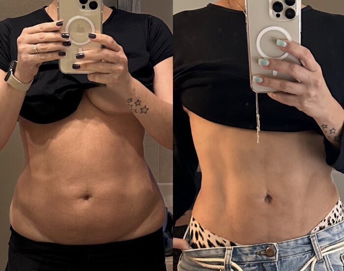 Breast Augmentation in Orlando, FL  Winter Garden
