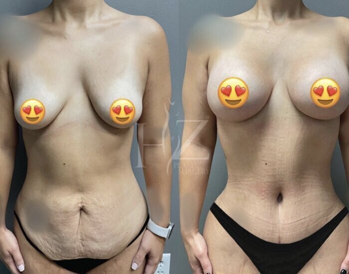 Breast Augmentation in Orlando, FL  Winter Garden