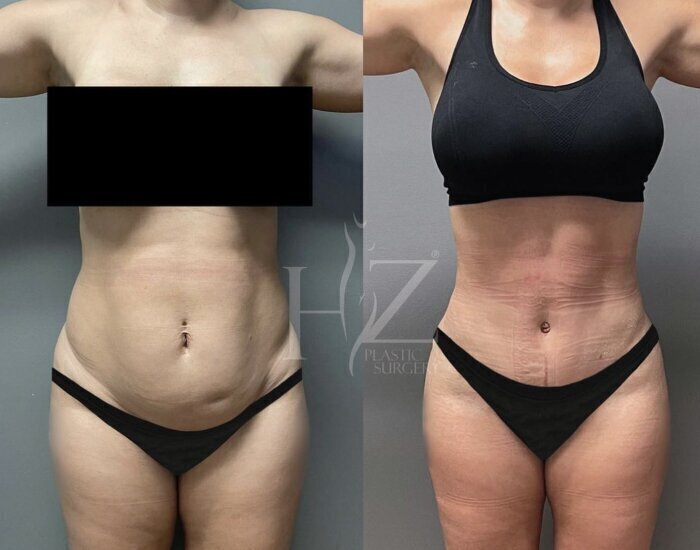 Breast Augmentation in Orlando, FL  Winter Garden