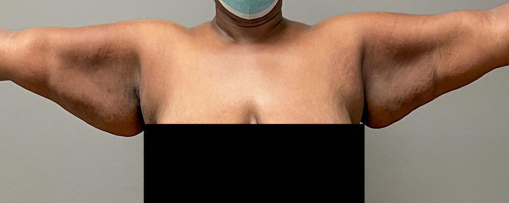 Sculptra Before & After Image
