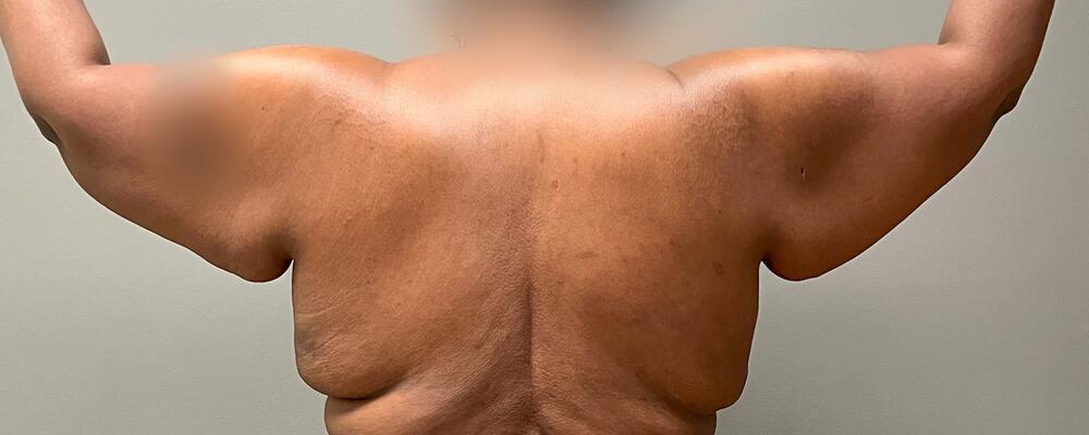 Arm Lift Before & After Image