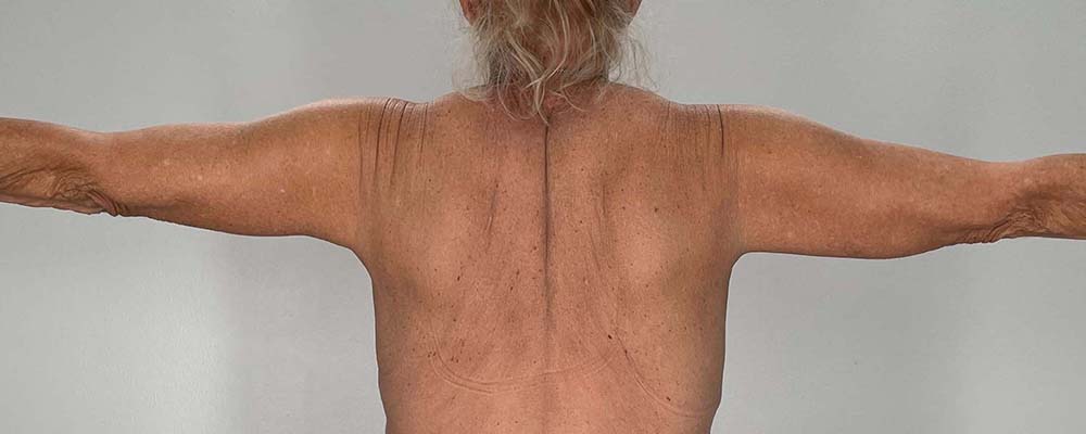 Arm Lift Before & After Image