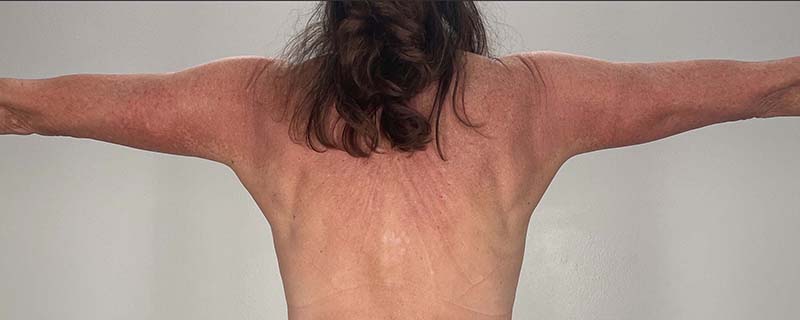 Arm Lift Before & After Image