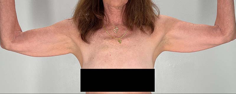 Arm Lift Before & After Image