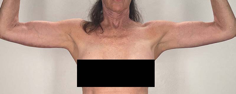 Arm Lift Before & After Image