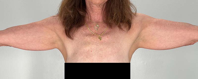 Arm Lift Before & After Image