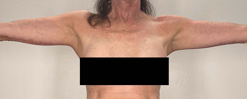 Arm Lift Before & After Image