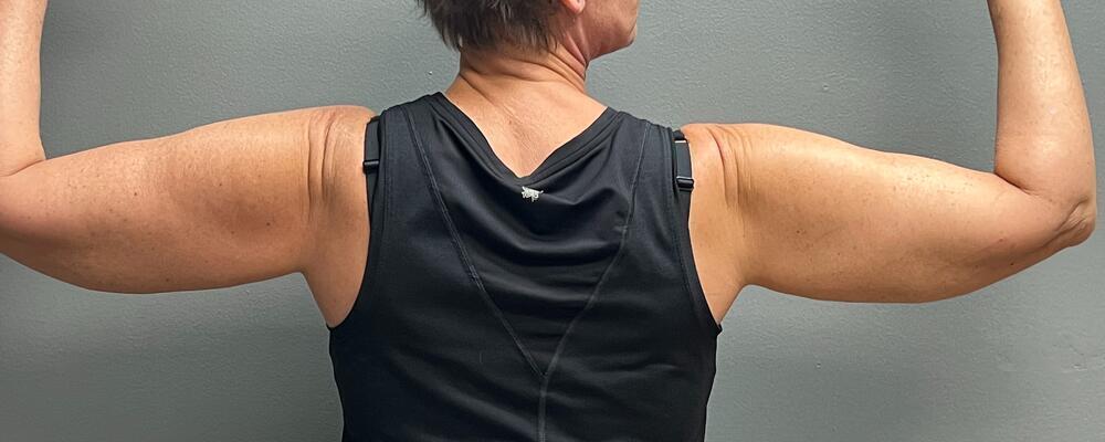 Arm Lift Before & After Image