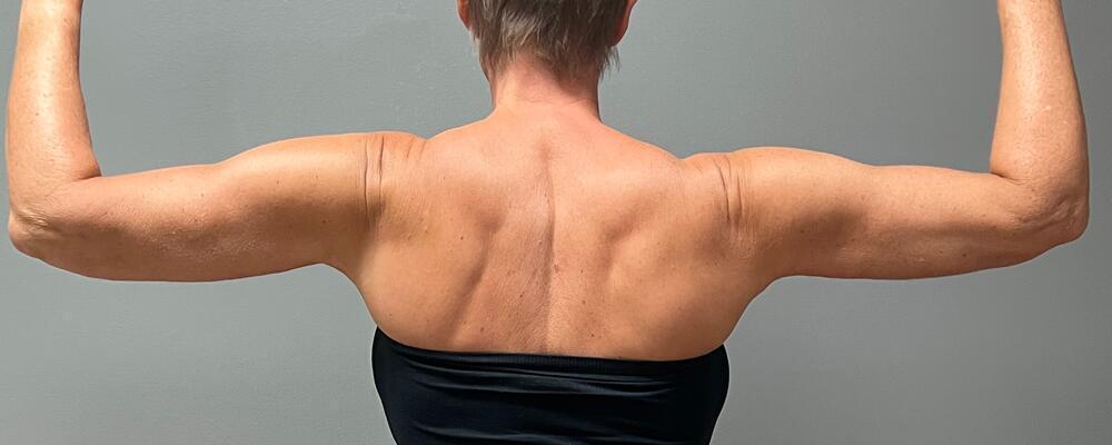 Arm Lift Before & After Image