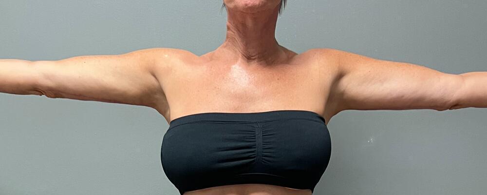 Arm Lift Before & After Image