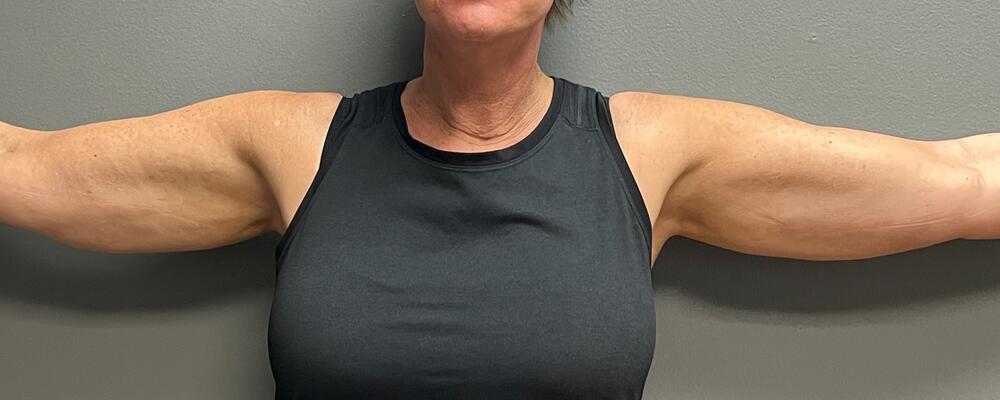 Arm Lift Before & After Image