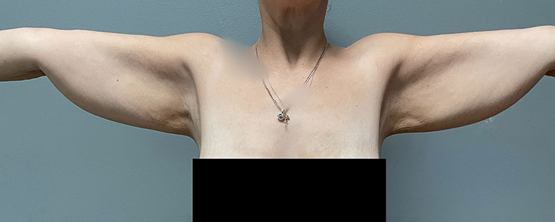 Arm Lift Before & After Image