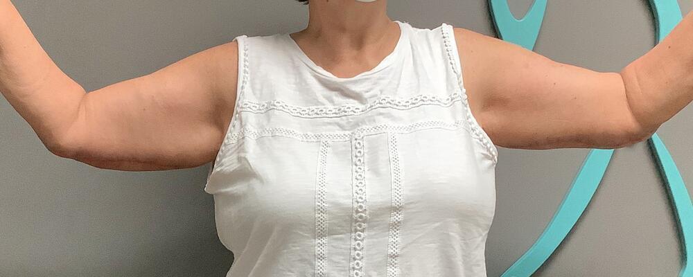 Arm Lift Before & After Image