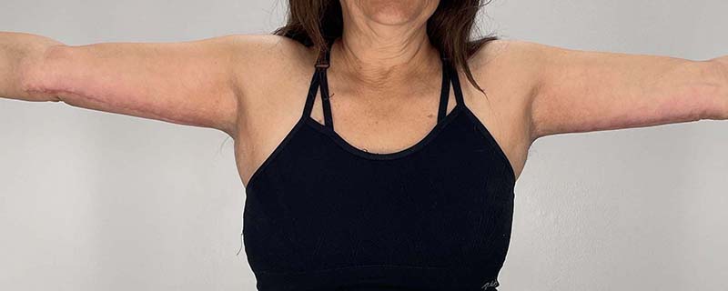 Arm Lift Before & After Image