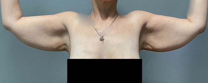 Arm Lift Before & After Image