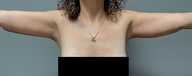 Arm Lift Before & After Image