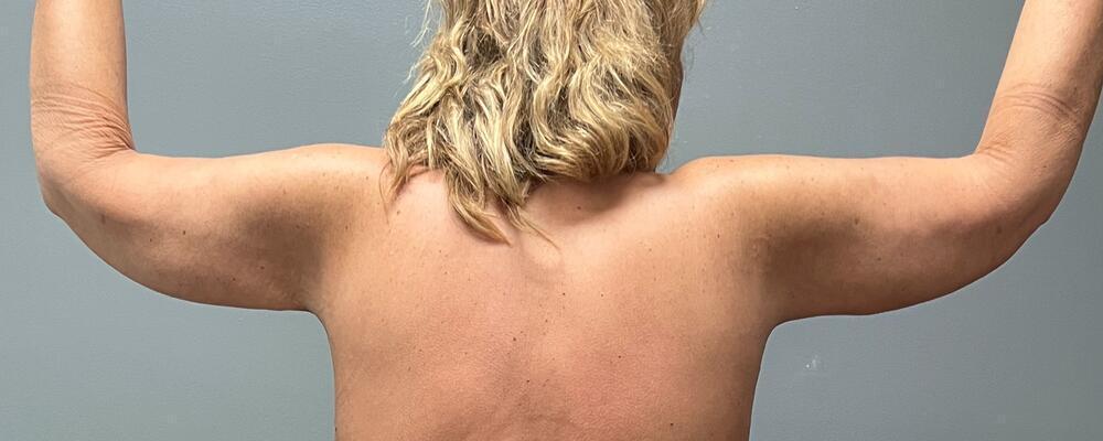 Arm Lift Before & After Image