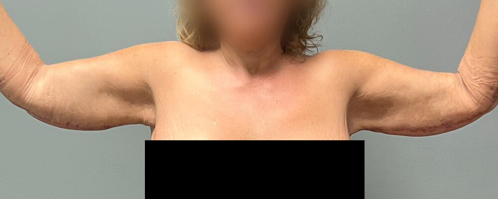 Arm Lift Before & After Image