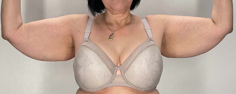 Arm Lift Before & After Image