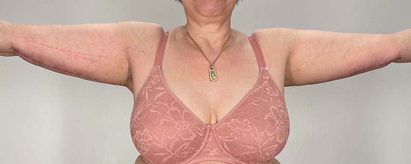 Arm Lift Before & After Image