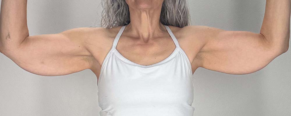 Arm Lift Before & After Image