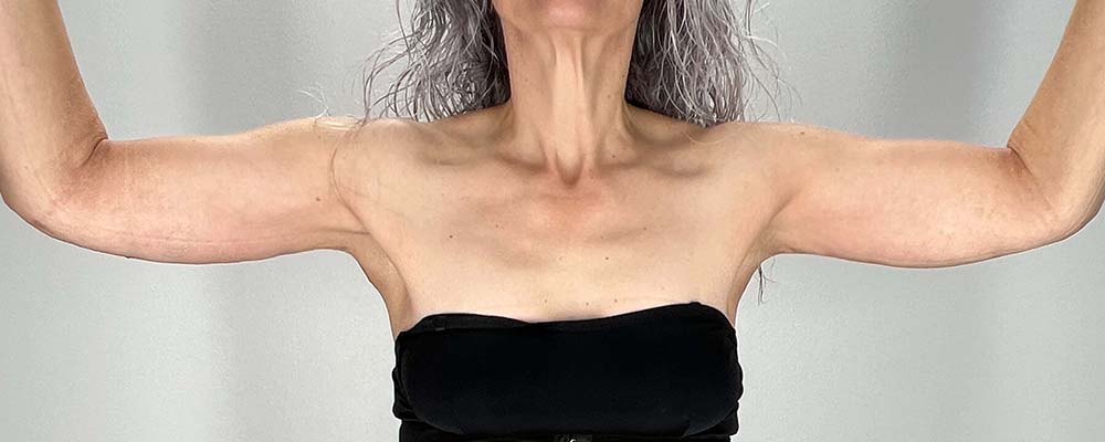 Arm Lift Before & After Image