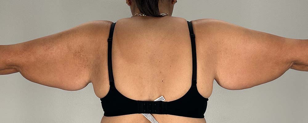 Arm Lift Before & After Image