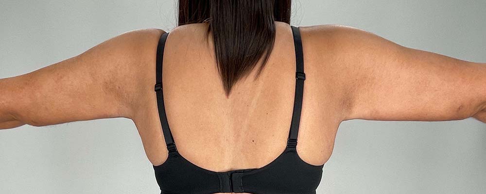 Arm Lift Before & After Image