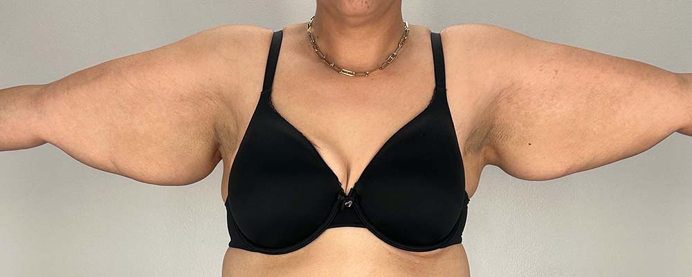 Arm Lift Before & After Image