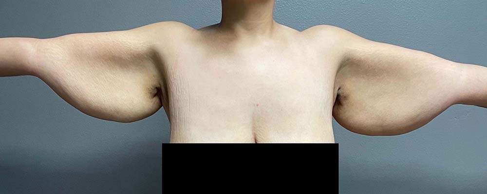 Arm Lift Before & After Image