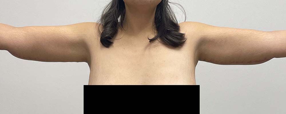 Arm Lift Before & After Image