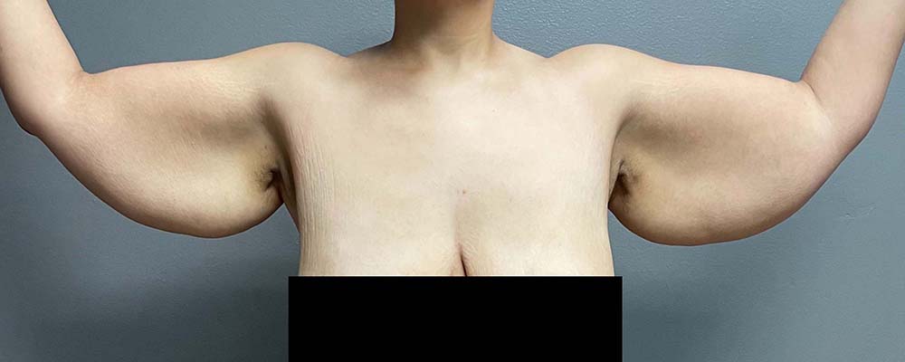 Arm Lift Before & After Image