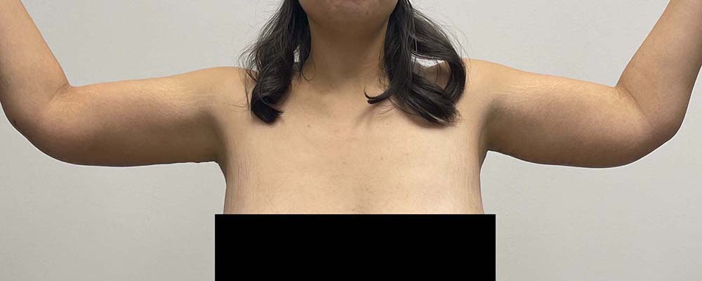 Arm Lift Before & After Image