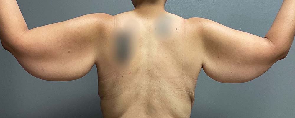 Arm Lift Before & After Image