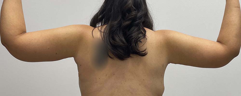 Arm Lift Before & After Image