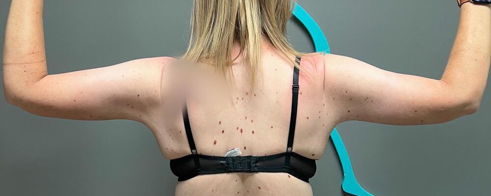 Arm Lift Before & After Image