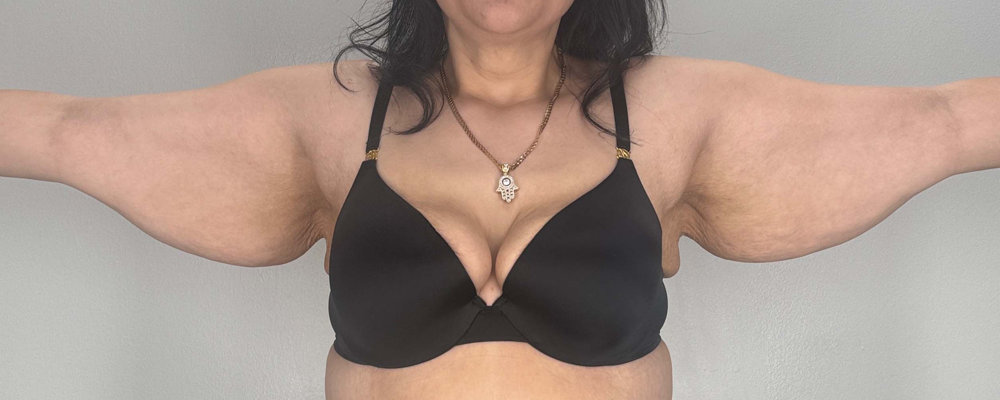 Arm Lift Before & After Image