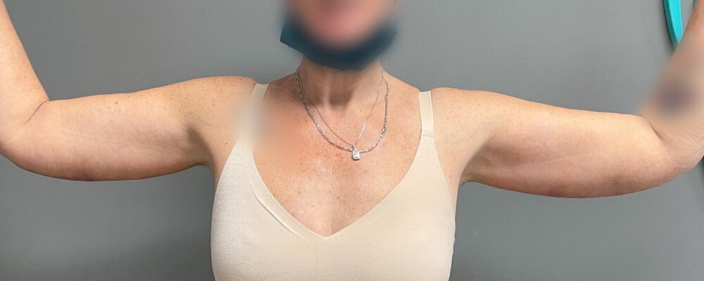 Arm Lift Before & After Image