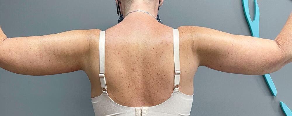 Arm Lift Before & After Image