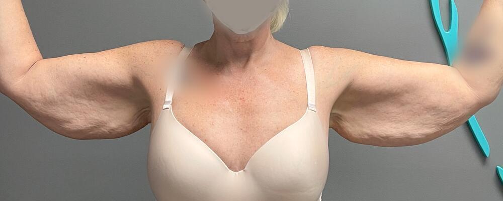 Arm Lift Before & After Image
