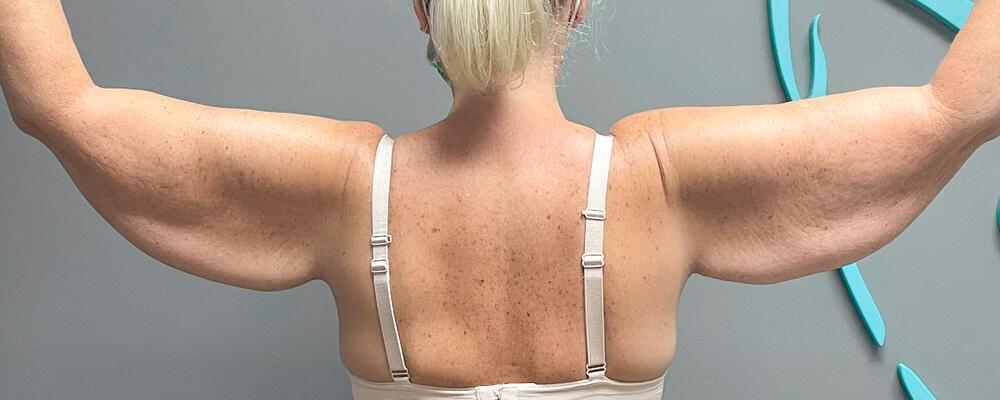 Arm Lift Before & After Image