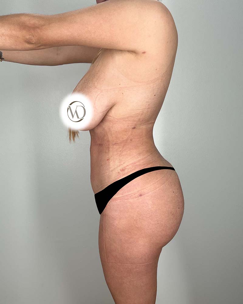 Brazilian Butt Lift Before & After Image