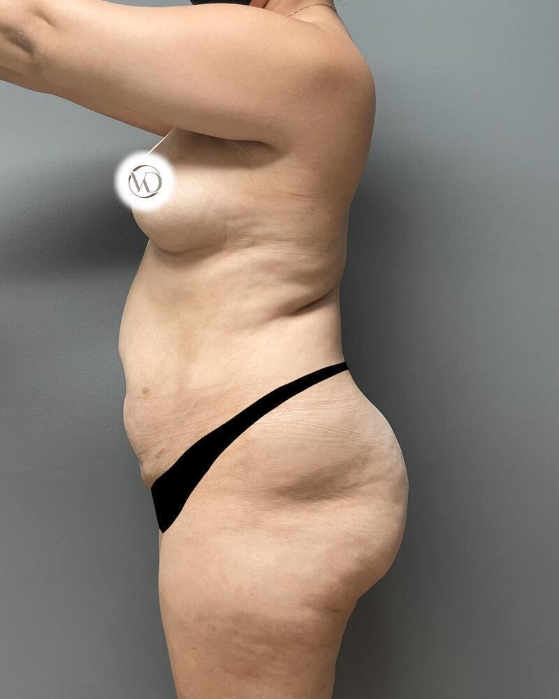 Brazilian Butt Lift Before & After Image